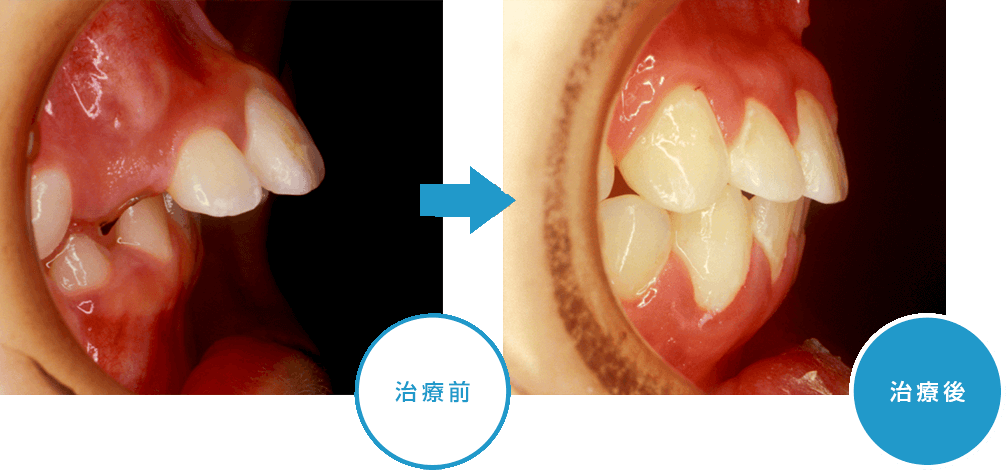 矯正治療のq A よこやま矯正歯科