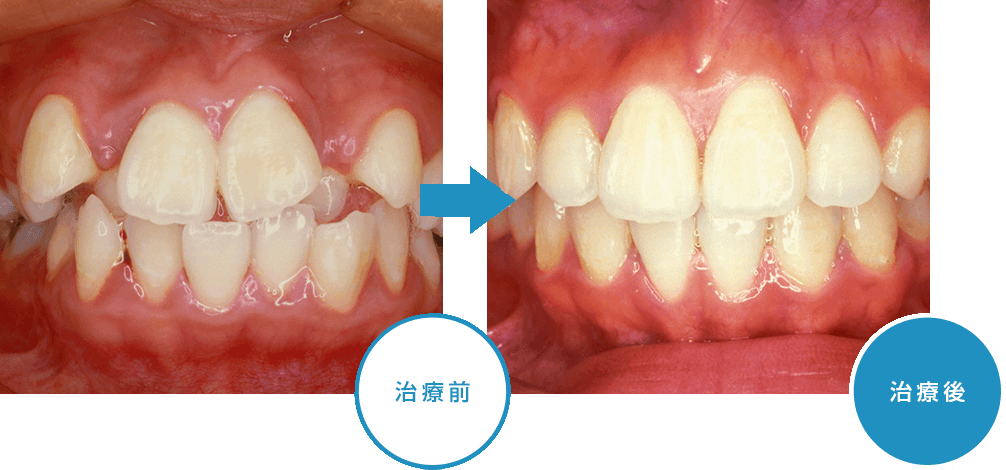 矯正治療のq A よこやま矯正歯科